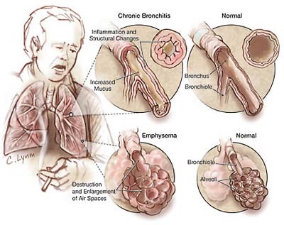 Emphysema X Ray. me xray showed Recently,