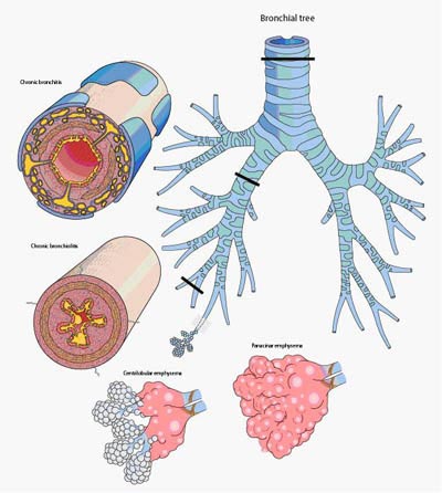 pictures of copd